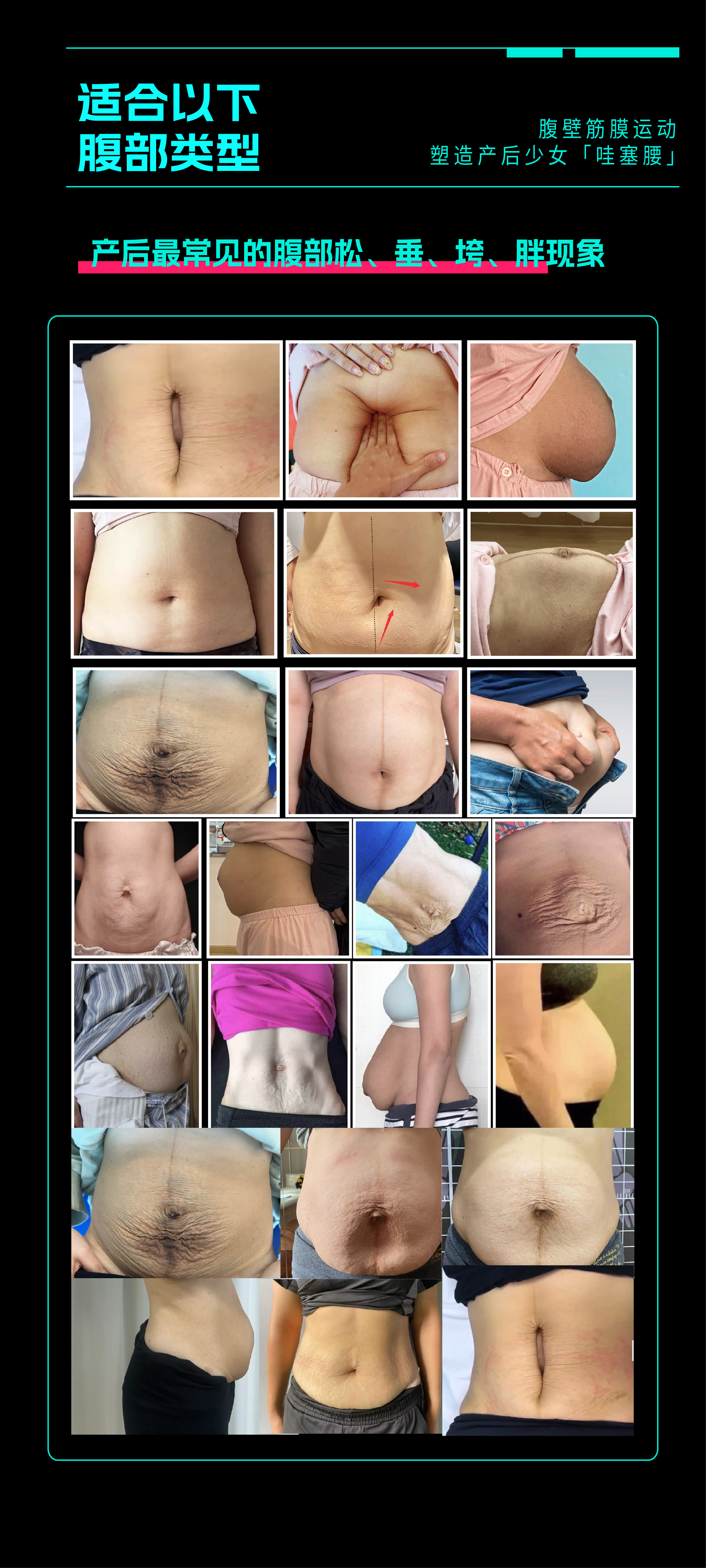 腹壁筋膜线上课程-02.jpg